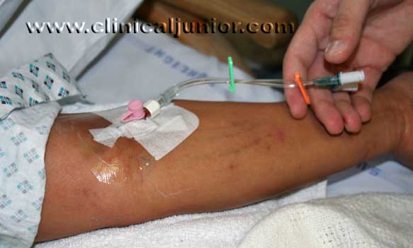 cannulation