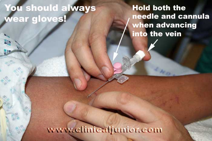 cannulation
