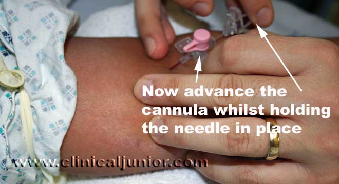 cannulation