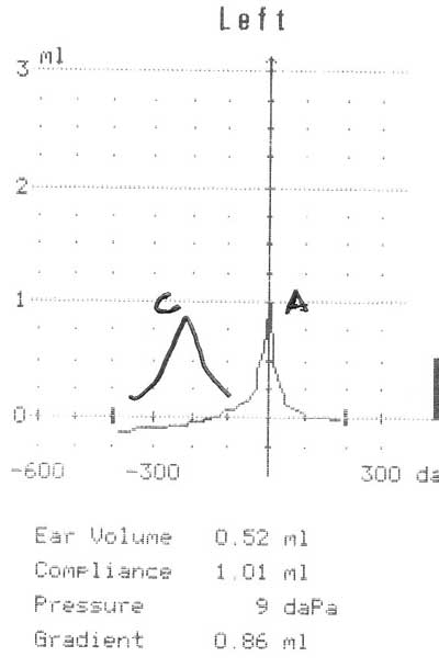 Tympanogram type c